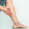 Facts About Chronic Venous Insufficiency