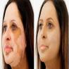 White Patch Removal Surgery in Lucknow