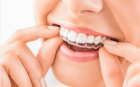 Transform Your Smile with Invisalign in Crystal City