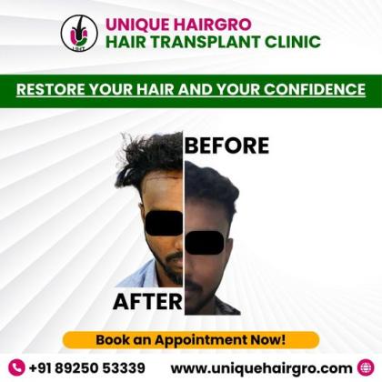 Best hair transplant clinic in tamilnadu