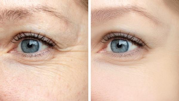 Dermal Fillers Guildford kingston