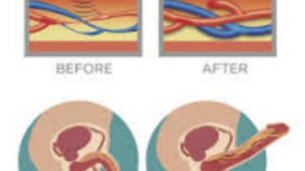 Erectile Dysfunction Treatment Near Me