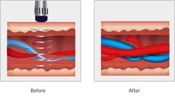 Erectile Dysfunction Treatment Shockwave