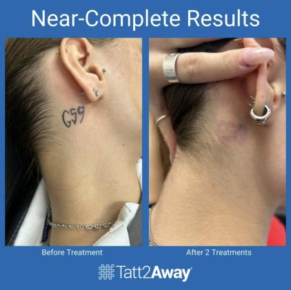 Tatt2Away® Clearwater