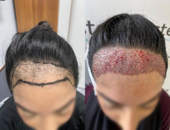 Where to get the Latest Innovations in Hair Restoration for Women