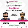 Best hair transplant clinic in tamilnadu