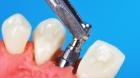 Dental Implant Crowns