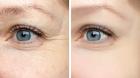 Dermal Fillers Guildford kingston