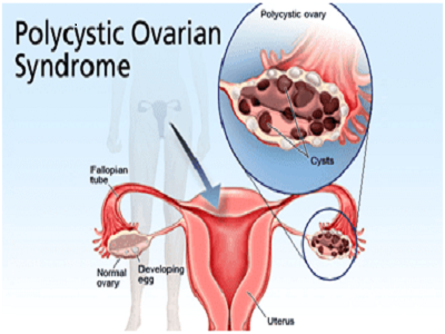 Best PCOS Specialist in NYC |Treatment at Sidhayur