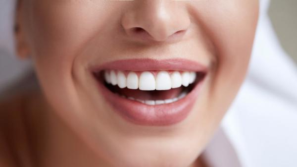Teeth Whitening
