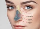 Rhinoplasty Surgery in Baner, Pune | Clinique Internationale