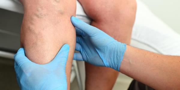 Experience the Future of DVT Treatment with Suction Thrombectomy