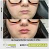 Dermal fillers or Juvederm Treatment in Louisville KY