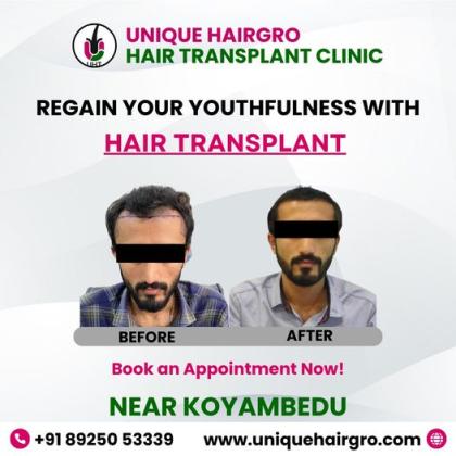 Best hair transplant clinic in tamilnadu