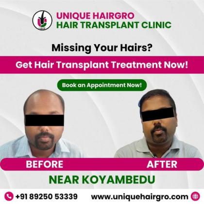 Best hair transplant clinic in tamilnadu