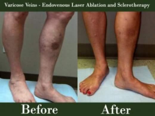 Center for Advanced Vein Care