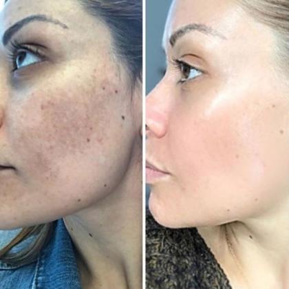Clear Skin with Isotroin 10