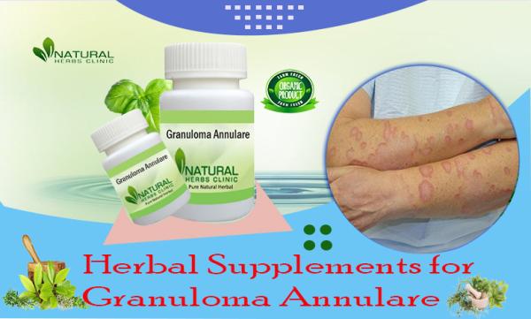 Herbal Remedy for Granuloma Annulare