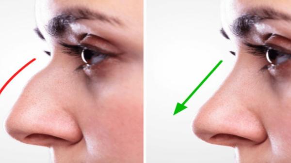 Rhinoplasty Nose Surgery In Punjab