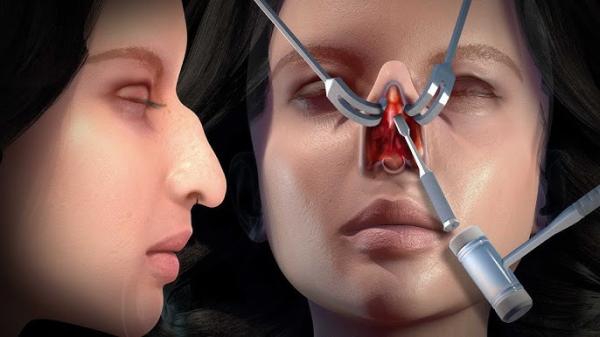 Rhinoplasty Specialist In Punjab