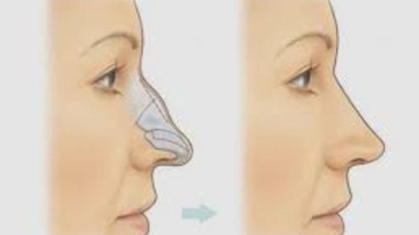 Rhinoplasty Specialist In Punjab