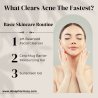 Accutane 40: One Of The Best Acne Cure Solution