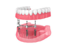 All-on-4 Dental Implants: A Simple Solution for a Full Smile