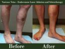Center for Advanced Vein Care