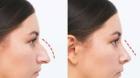 Rhinoplasty Nose Surgery In Punjab