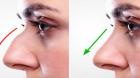 Rhinoplasty Nose Surgery In Punjab