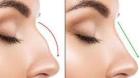 Rhinoplasty Specialist In Punjab