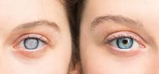 Best cataract surgery in Madurai