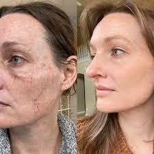 Best Plastic Surgery In Cherry Creek