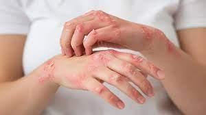 Buy Valtrex, an effective cold sore treatment.