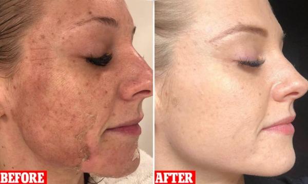 Enhance Your Skin: The Miracle of Dermaplane Facial