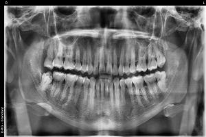 Full mouth dental implants in Mexico
