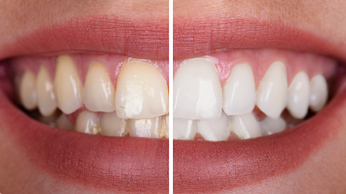 Zoom Teeth Whitening