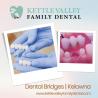 Dental Bridges In Kelowna