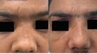 Rhinoplasty Specialist In Punjab