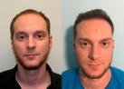 Top Hair Loss Treatment in Boston: What You Need to Know