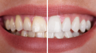 Zoom Teeth Whitening