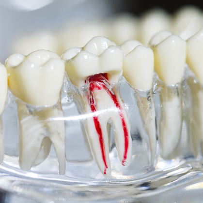 5 Red Flags Your Tooth Needs a Root Canal |Root canal in Frisco