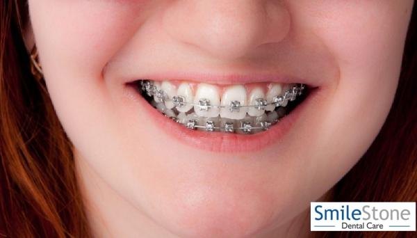 Best Smile design in Nagpur
