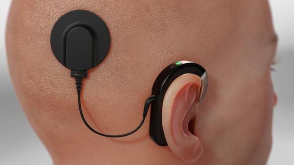 Cochlear Hearing Implants