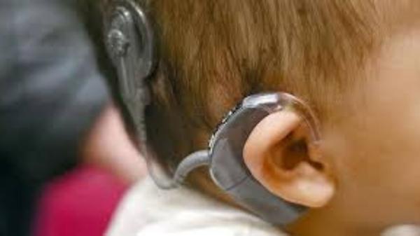 Cochlear Hearing Implants