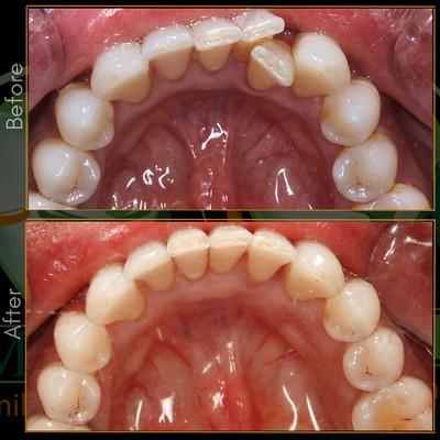 Dental Implants Columbus in Ohio -  Dublin Metro Dental