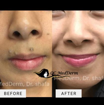 Mole removal Specialist Dr. Parvin Shafa in Irvine, CA - OC MedDerm