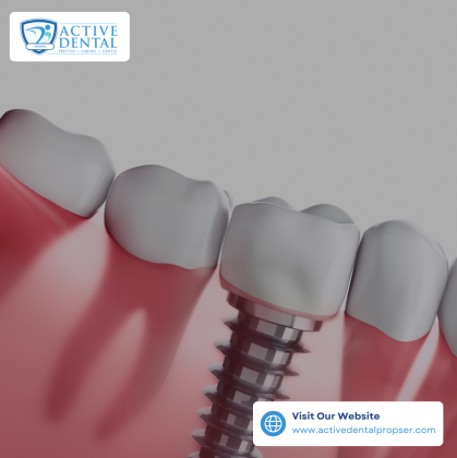 Transform Your Smile with Dental Implants in Prosper