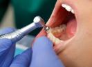 Affordable Dental Work in Tijuana, Mexico | Quality Dental Care & Implants