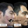 Best Acne scar treatment by Dr.Shafa in Irvine, Califonia - OC MedDerm